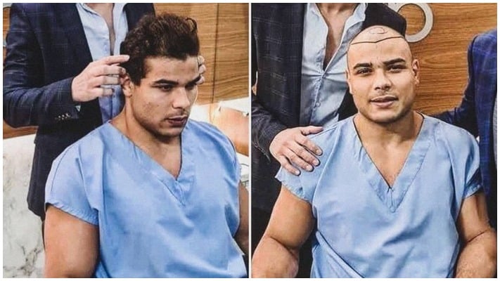 Paulo Costa Roasted By UFC Middleweights For Getting a Hair Transplant