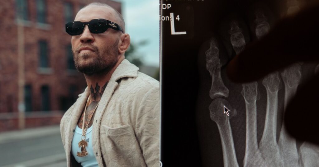 Photos - Conor McGregor Reveals Fractured Toe Injury In X-Ray Images ...