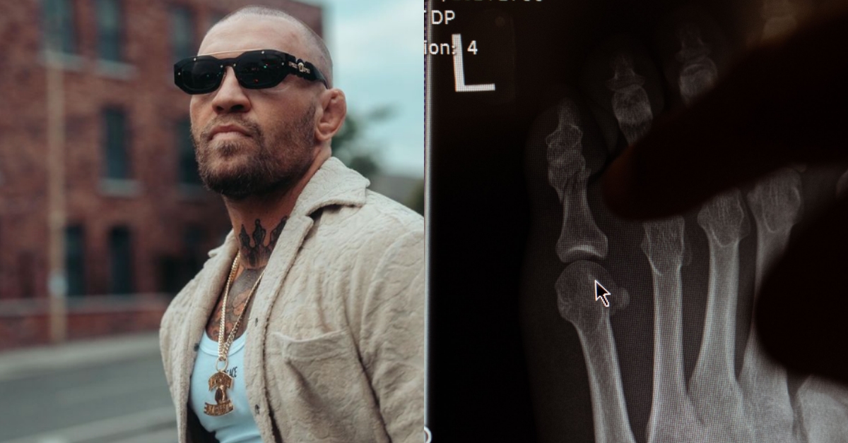 Conor McGregor reveals fractured toe injury in x-rays amid exit from UFC 303 fight