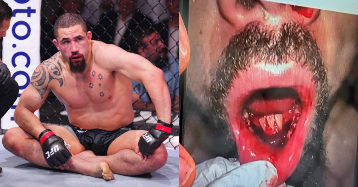 Robert Whittaker suffers broken teeth, dislocated jaw in submission loss at Khamzat Chimaev at UFC 308