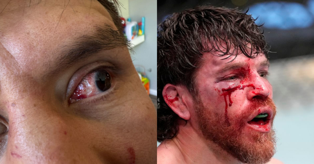 Will It Take Someone Losing an Eye – Jim Miller Rips UFC’s Lack of Action on Eye Pokes